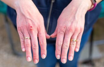 5 Key Factors in Personal Injury Settlement Value Home