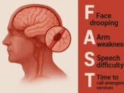 Why Quick Stroke Diagnosis Can Save Lives: Time Matters